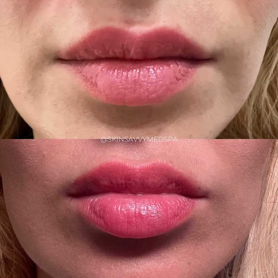 Custom Lips | New Patient Promo