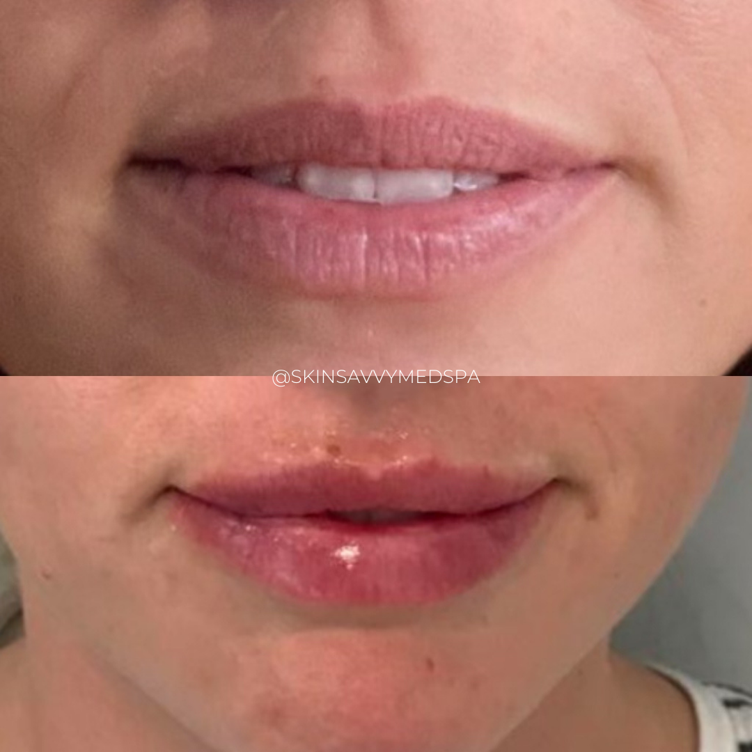 Custom Lips | New Patient Promo