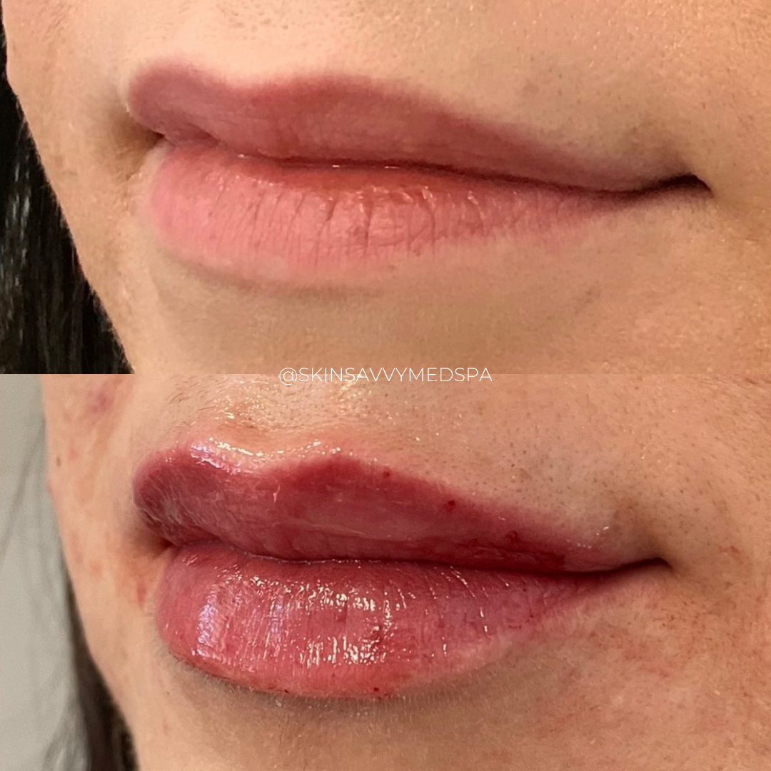 Custom Lips | New Patient Promo