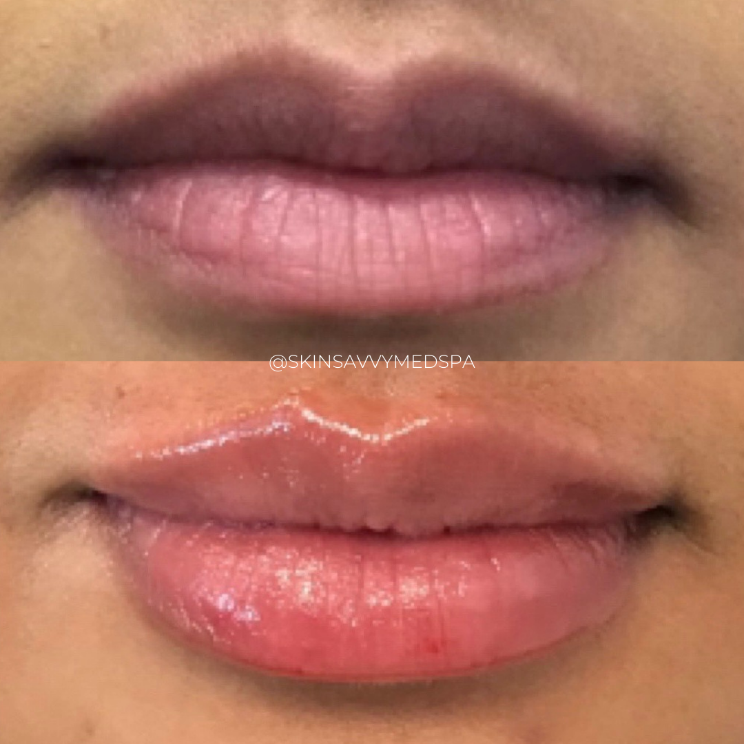 Custom Lips | New Patient Promo