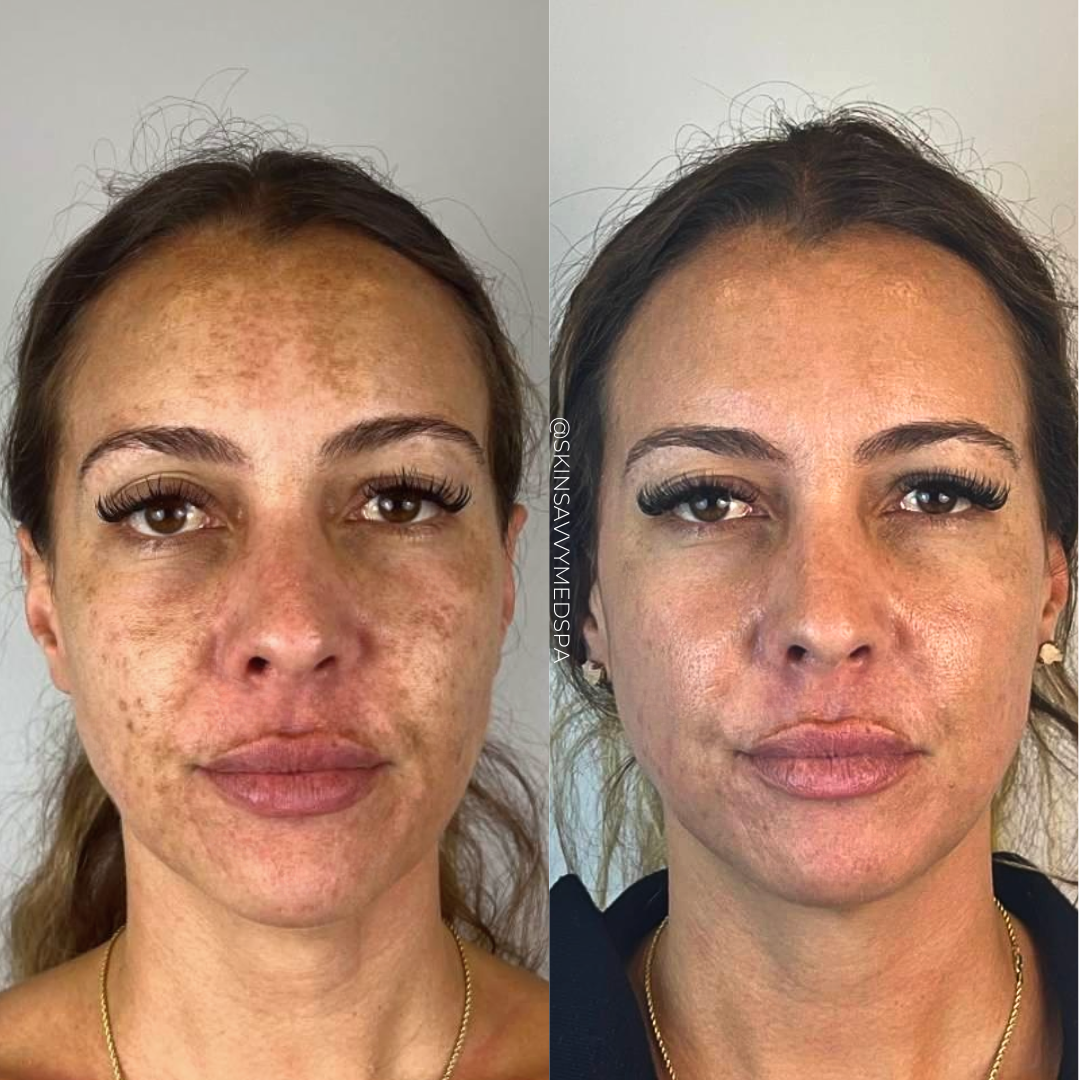 Sun Damage Repair | IPL Photofacial