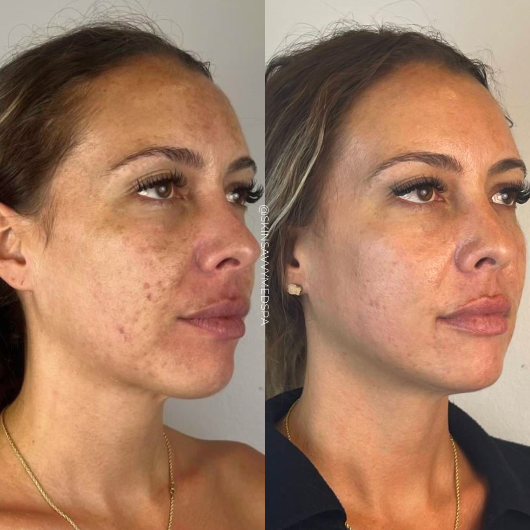 Sun Damage Repair | IPL Photofacial