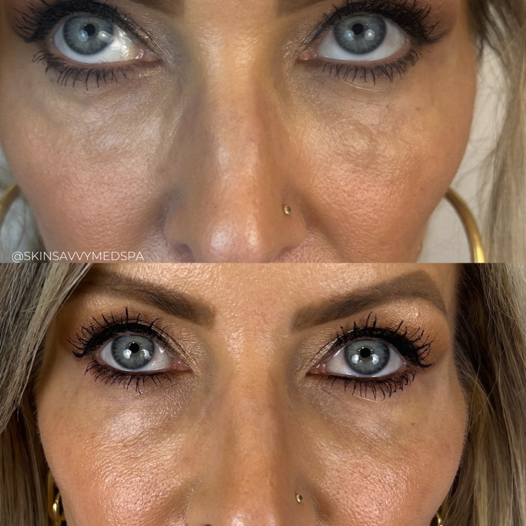 Under Eye Treatment | Special Offer