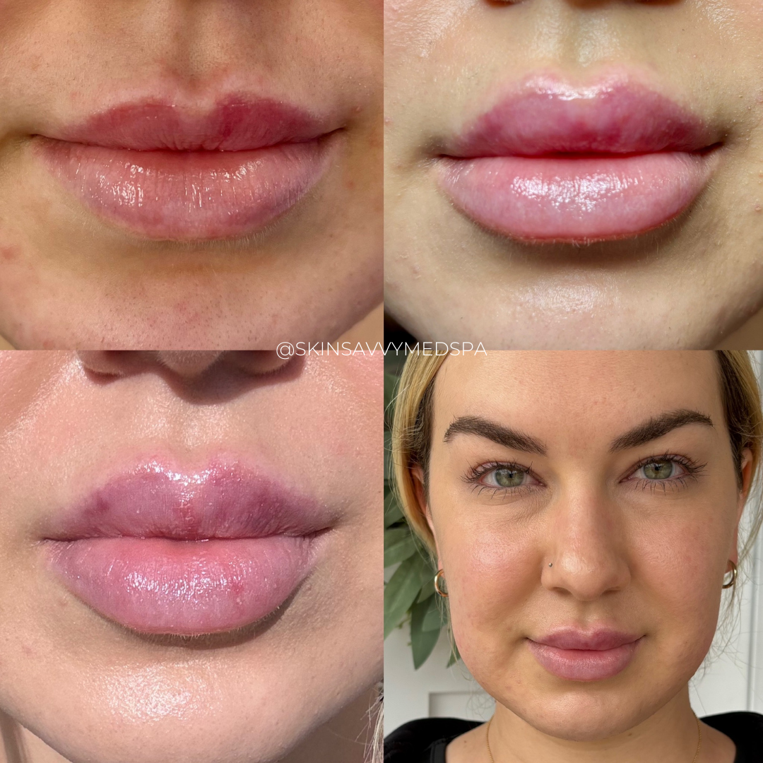 Custom Lips | New Patient Promo