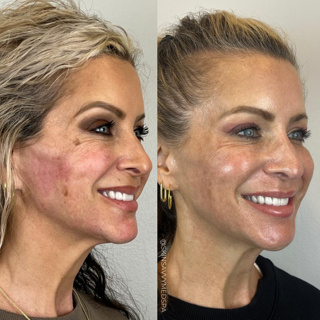The Filler Flash Pack | Summer Offer
