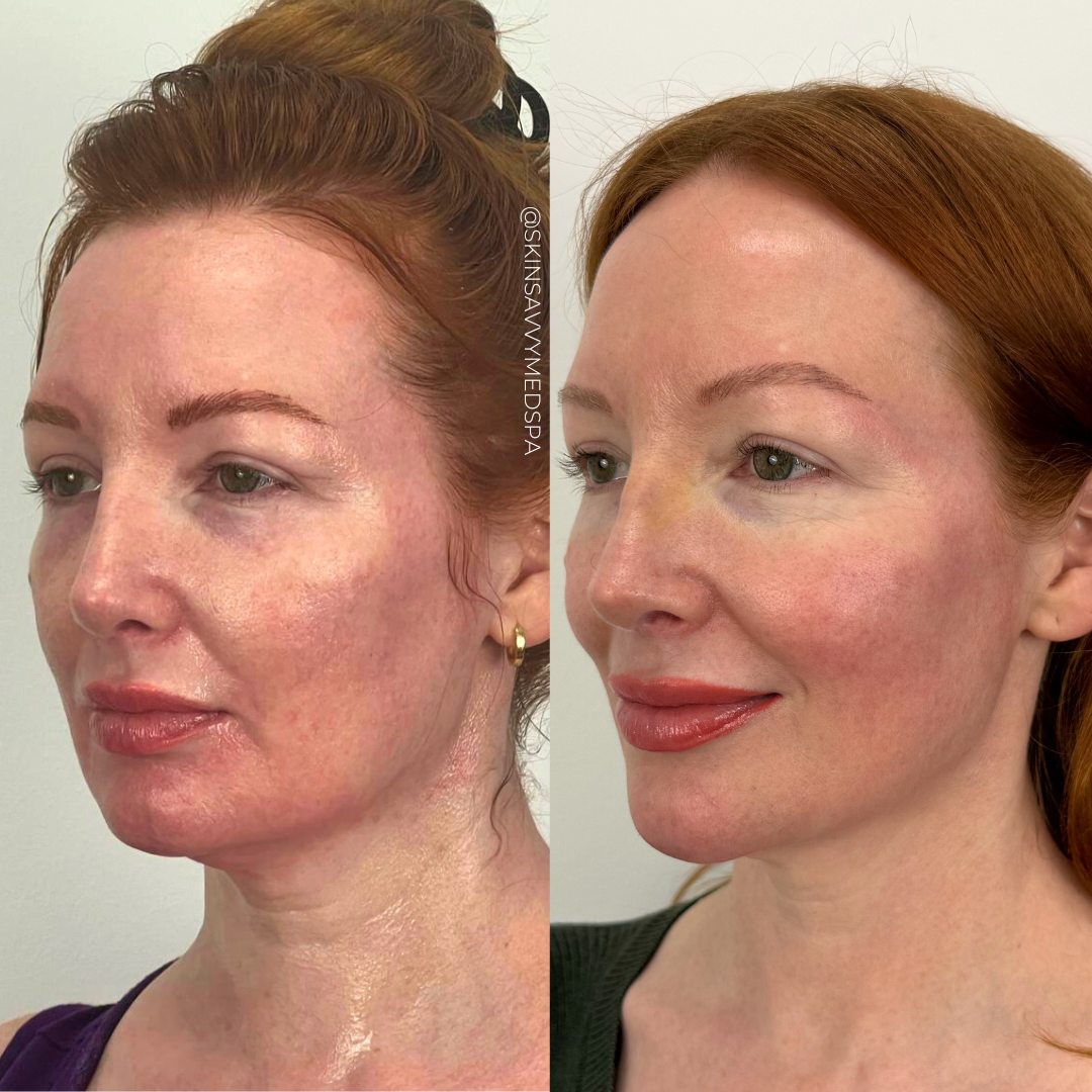 The Filler Flash Pack | Summer Offer