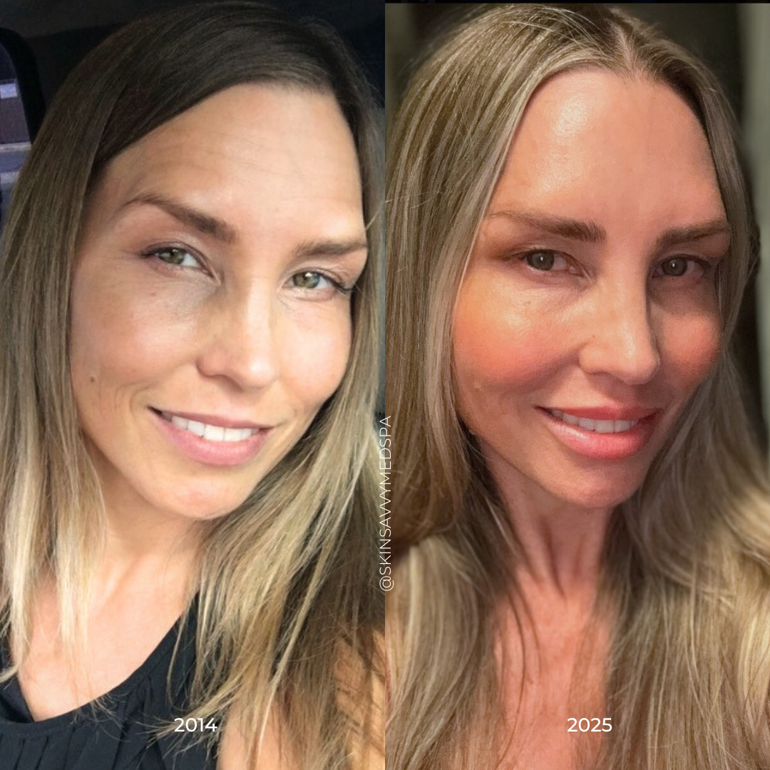 The Filler Flash Pack | Summer Offer