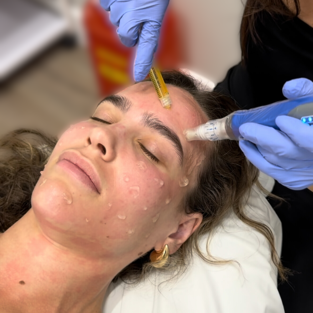 Black Friday | Microneedling With PRP