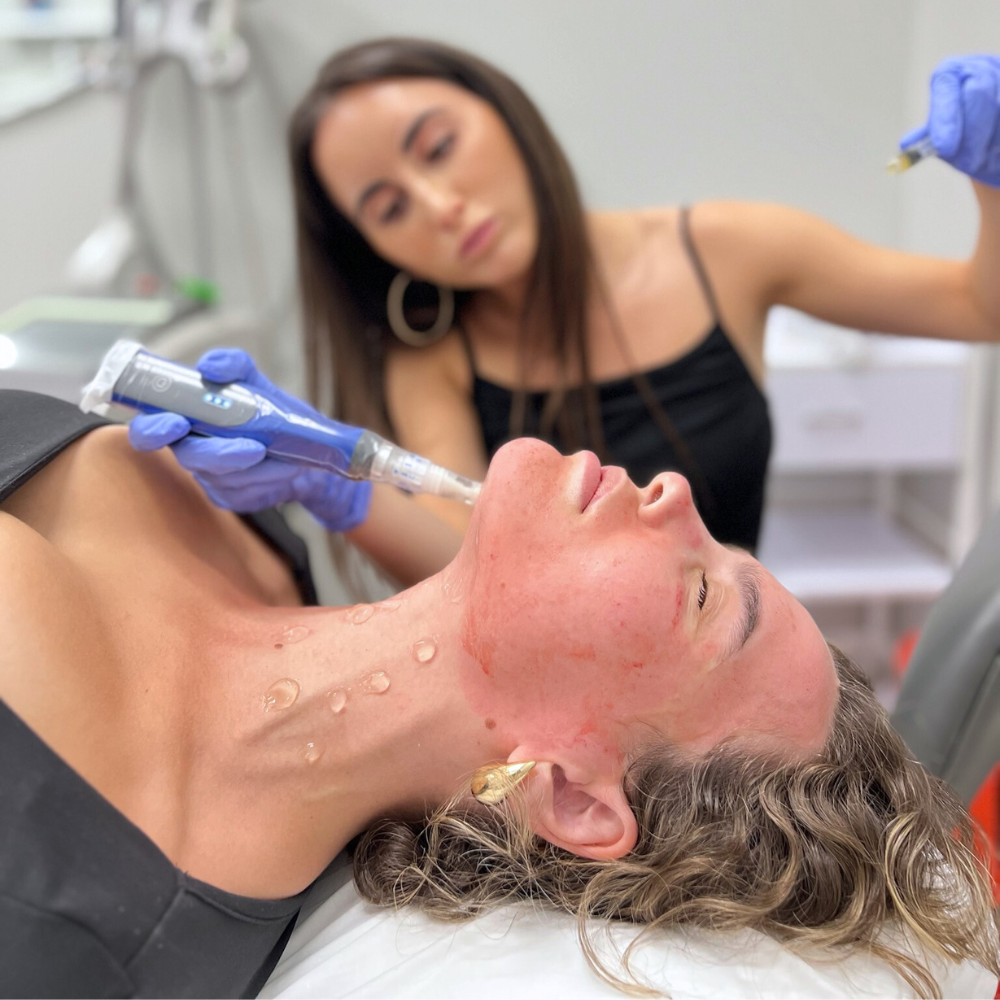 Microneedling | PRP Microneedling