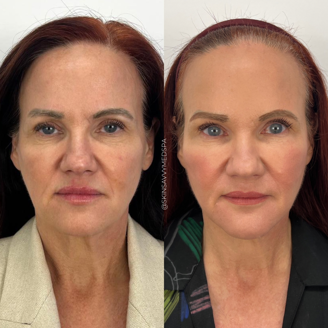 Under Eye Treatment | Special Offer