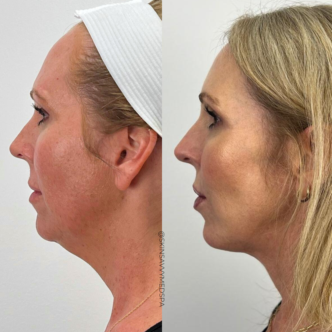The Filler Flash Pack | Summer Offer
