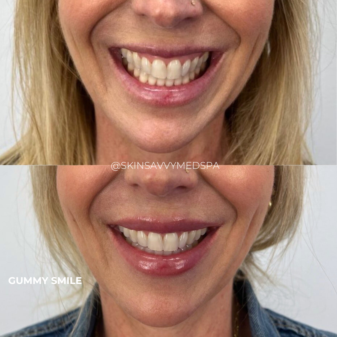 Savvy Tox | New Patient Offer