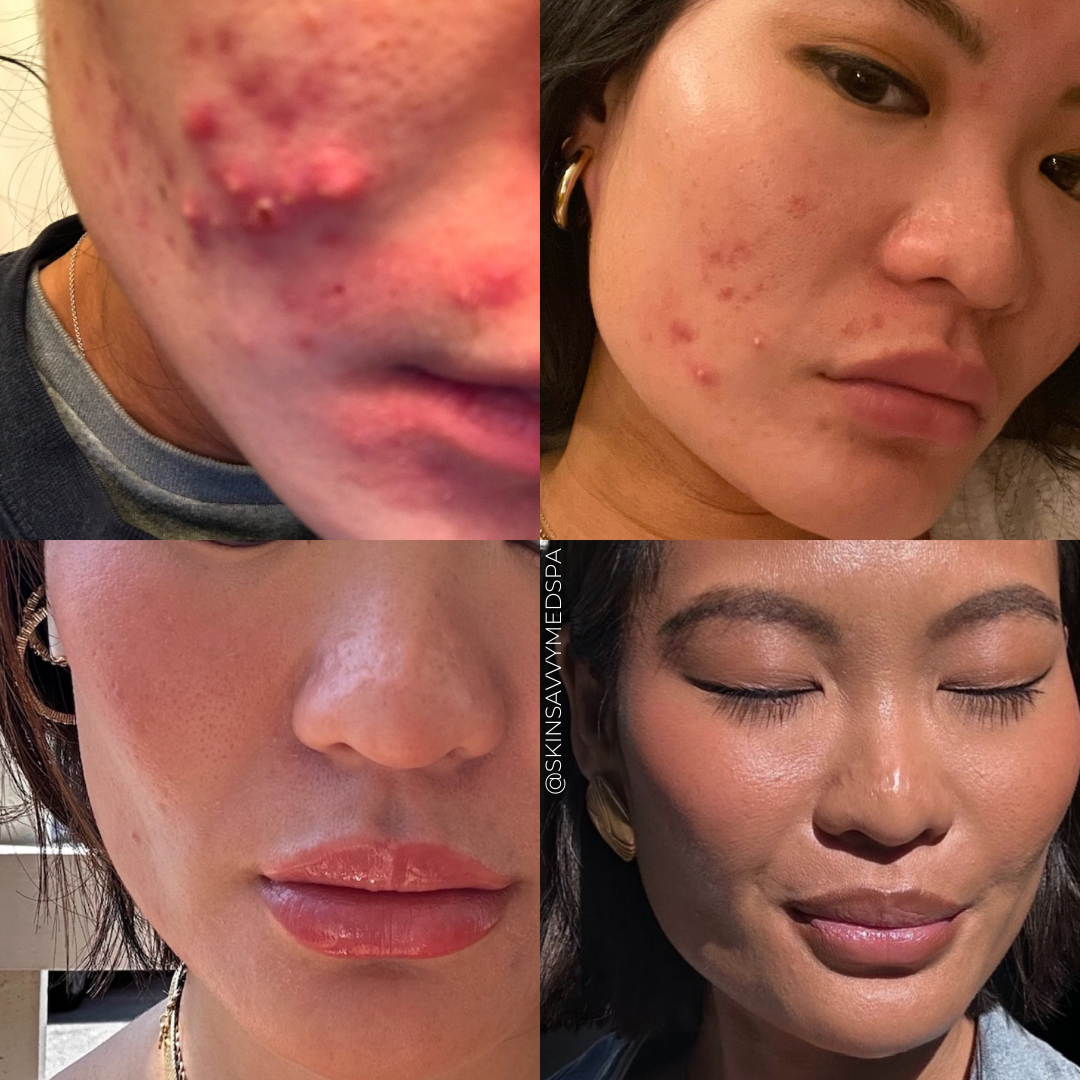 Custom Facials | First Time Treatment Offer