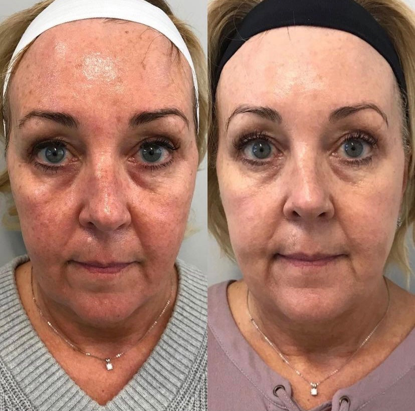 IPL PHOTOFACIAL FACE + NECK + CHEST PACKAGE